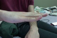 Pinky hyper extension.jpg